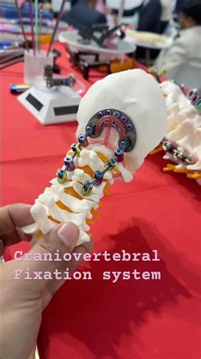 Spinal fixation systems| posterior instrumentation🦴 #spine #spinesurgery #spinetreatment #implants