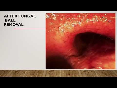 Bronchoscopy in ICU Dr Reda Ibrahim