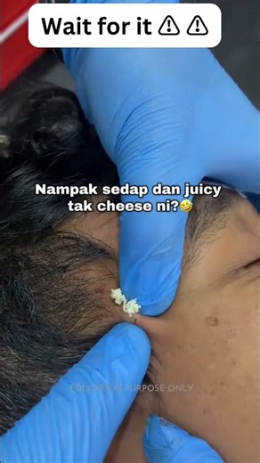 Huge pimple sqiorts everywhere