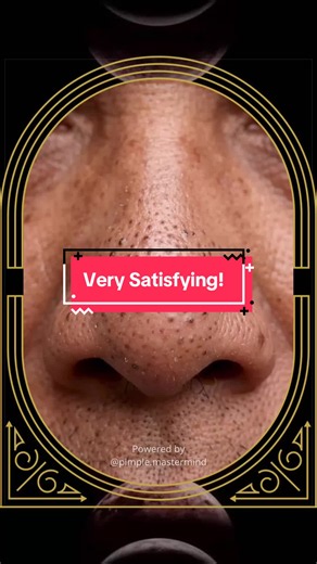 Blackheads removal at SPA Skincare Satisfying Video #blackheadsremoval #blackhead #acnetreatment #skincare #satisfying
