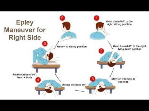 Epley Maneuver treatment for Benign Paroxysmal Positional Vertigo ; Definition, Steps, Uses