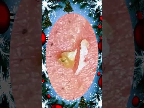 Blackheads Removal | Acne Treatment and Very Satisfying Satisfying Pimple pop #blackheads