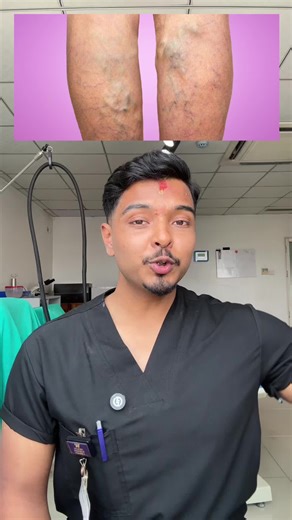 Understanding Varicose Veins: Causes and Treatment