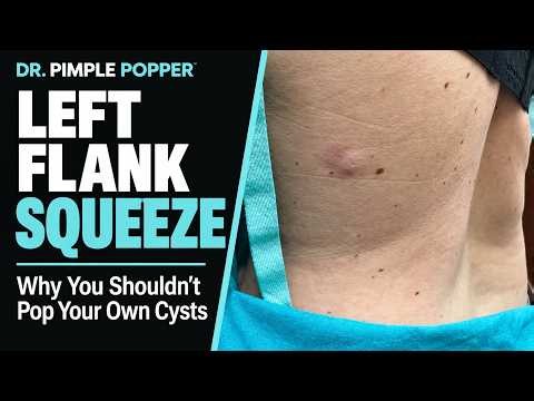 Why You Shouldn't Pop Your Own Cysts | Dr. Pimple Popper vs. Flank Squeeze
