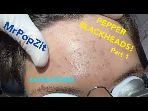 So many blackheads! 22 minutes of just the pop! See his transformation. Black pepper pore plugs!