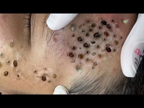 𝐁𝐢𝐠 𝐂𝐲𝐬𝐭𝐢𝐜 𝐀𝐜𝐧𝐞 𝐁𝐥𝐚𝐜𝐤𝐡𝐞𝐚𝐝𝐬 𝐄𝐱𝐭𝐫𝐚𝐜𝐭𝐢𝐨𝐧 𝐁𝐥𝐚𝐜𝐤𝐡𝐞𝐚𝐝𝐬 #𝟓𝟑𝟐𝟗69