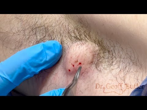 Drainage of an Inflamed Cyst in the Axilla