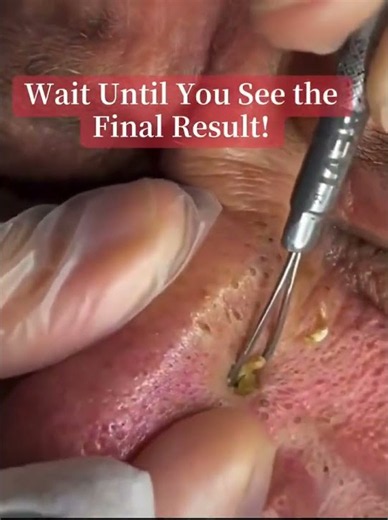 #BlackheadRemoval #Blackheads #Skincare #OddlySatisfying