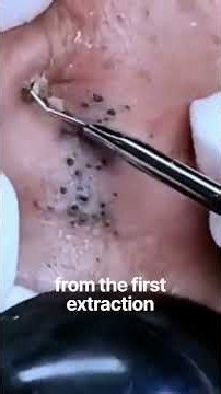 #blackheads #blackheadremoval #blackheadextraction #skincare#cloggedpores#pores#youtubeshorts#shorts