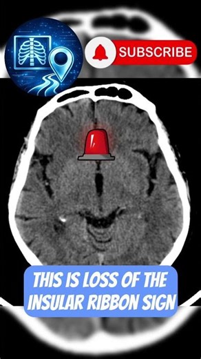 One Subtle CT Sign You Can’t Miss #Radiology #neurology
