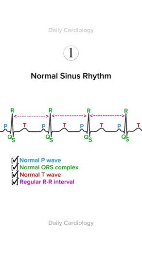 ECG interpretation with Normal sinus rhythm #ecg #ekg #ecginterpretation #cardiology