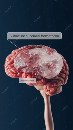 Blood Beneath the Dura: Traumatic Subdural Hematoma in 3D