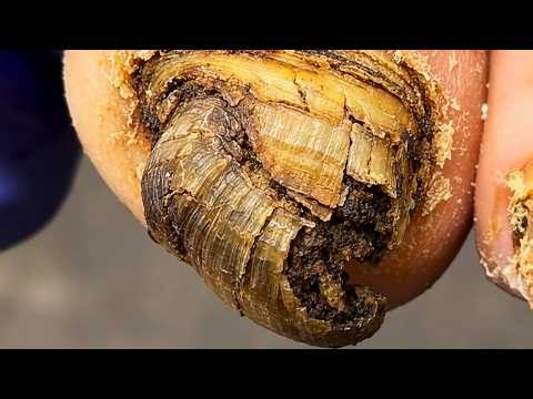 Severe Ingrown Toenail Buried Deep, Complete Relief Process【Dr. Liu's Pedicur】