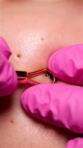 Viral Pimple Popping Compilation (USA) – Satisfying Acne Removal!