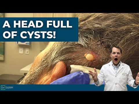 Head Full of Pilar Cysts! | Dr. Derm