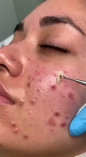 Relax Everyday With Sac Dep Spa Blackheads | Gigantic Blackhead Removal | Dep Sac Spa #145