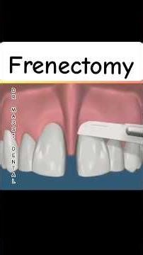 Frenectomy: Closes or prevents a gap between front teeth