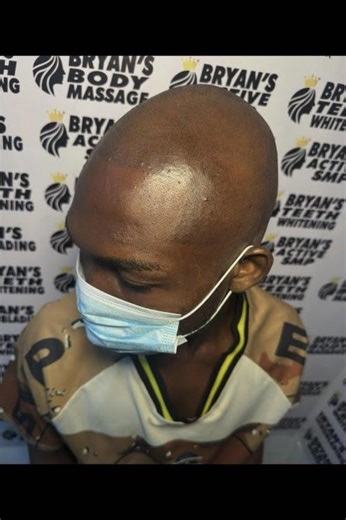 Scalp Micropigmentation SMP Hair loss and baldness