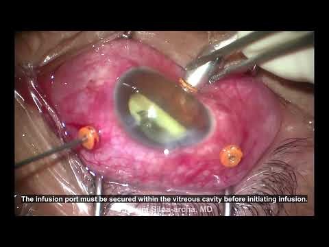 V341 A Hole in the Pus or the Retina: The Mystery During Vitrectomy