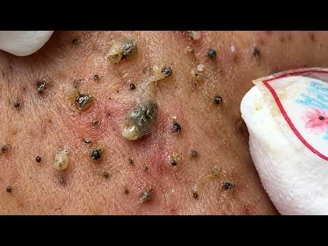 Extreme Blackhead Removal #1 | Satisfying Pimple Pop & Deep Skin Cleaning #Blackheads
