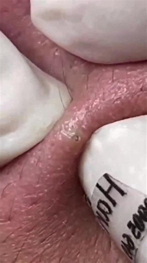 PimplePopping #BlackheadRemoval #skincare #satisfying | Skincare Videos