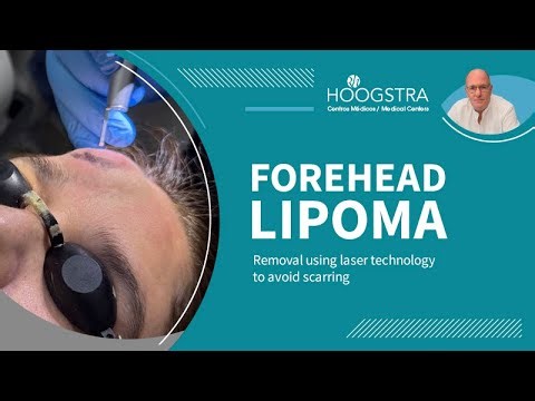 Forehead lipoma removed with laser - 25185