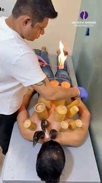 FAST Ankylosing Spondylitis Relief: Fire Cupping + Chiropractic + Acupuncture Combo! #drravishinde