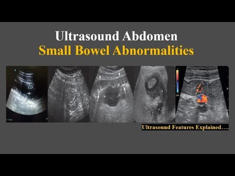 Ultrasound features of small bowel abnormalities || Radiology cases tutorial