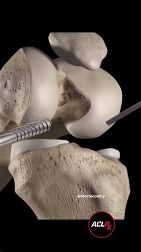 ACL Surgery in 16 Seconds