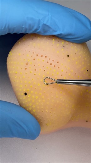 Satisfying Yellow Pimple Popping ASMR 🤯🟡