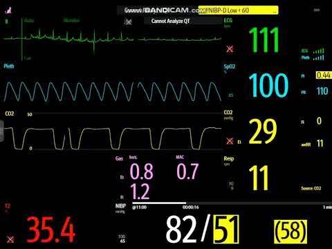Hypotension and Bradycardia During Feline TECA Anesthesia: Glycopyrrolate Response in Real Time