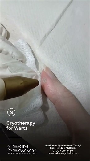 SAY GOODBYE TO STUBBORN WARTS!