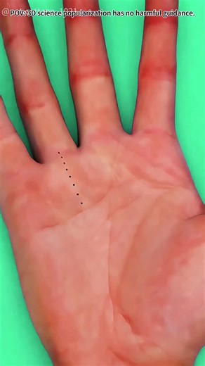 How Trigger Finger Release Surgery Is Done (3D Animation) #3dmedicalanimation #medical3danimation #handsurgery #triggerfinger #orthopedicsurgery