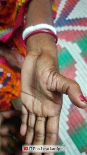 Finger Dislocation l হাতের আঙুল সরে গেলে কী করবেন #short #finger #dislocation🔥🔥🔥