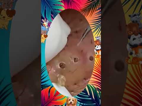 Blackheads Removal | Acne Treatment and Very Satisfying Satisfying Pimple pop #blackheads