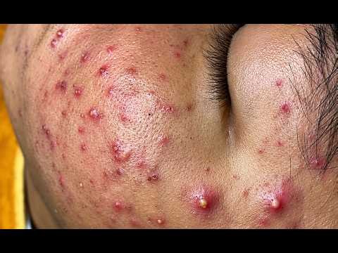 NEW 2026 – Extreme Close-Up Pimple Extraction Session #10291