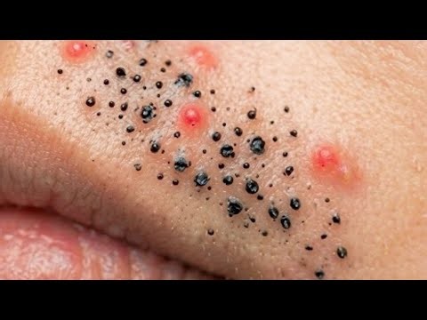 😱 EXTREME PIMPLE POPPING! 🤯 SATISFYING BLACKHEAD EXTRACTIONS | #PimplePopping #Blackheads #ASMR