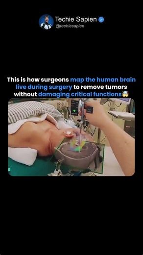 This Is How Surgeons Map the Human Brain LIVE During Surgery 🧠⚡