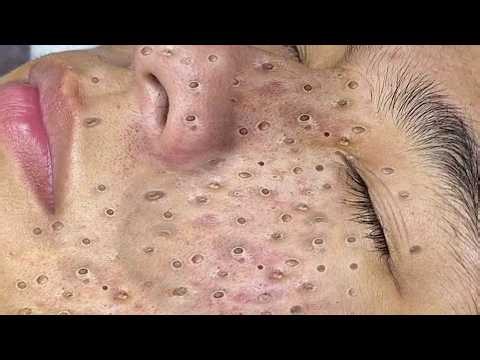 Pimple Popping Extreme Blackheads & Satisfying Extraction