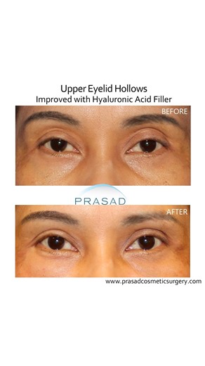 Uneven Eyelids: Treating Hollowness Without Surgery #uneveneyes