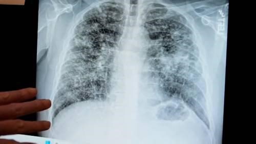 Scientists at St. Michael’s Hospital seek to revolutionize lung imaging | Watch News Videos Online | St. Michael s Hospital Foundation