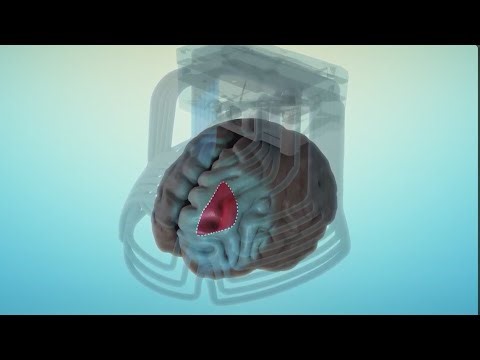 TMS (transcranial magnetic stimulation): Treatment for depression/anxiety