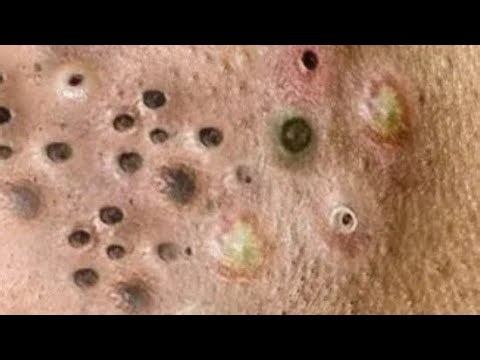 Deep blackhead Removal 2026, acne removal spa, big pimple 2026, #acne #pimple #cyst