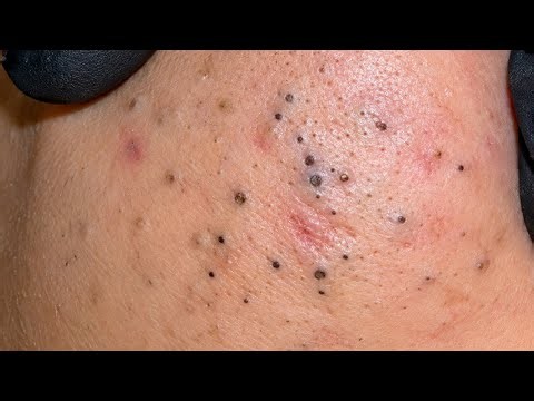 Deep Blackhead Removal | Glass Skin Transformation for acne removal & Facial Cleansing Routine