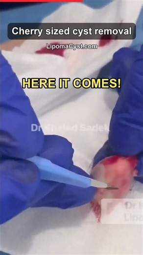 Cherry Sized Cyst. Video Out Now. Dr Khaled Sadek. LipomaCyst.com