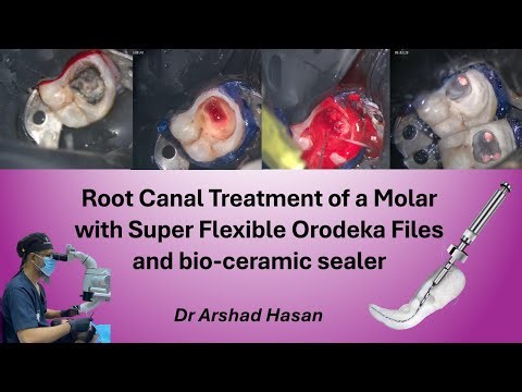 Root Canal Treatment of a Molar with Super Flexible Orodeka Files and Bio-Ceramic Sealer