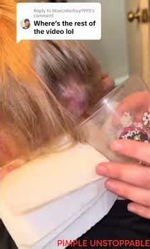 INSANE PIMPLE POP! HUGE CYST #pimplepopping #pimple #cysts #pimpleproblem