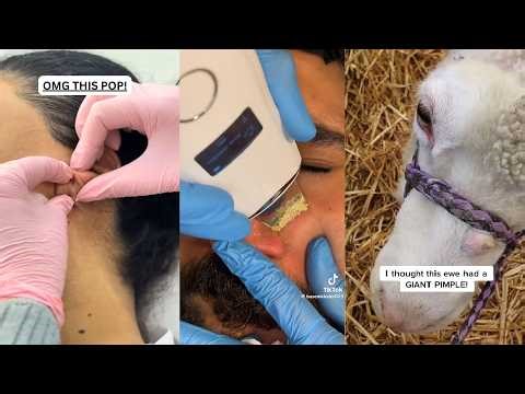 Popping huge blackheads and Pimple Popping - Best Pimple Popping Videos 304