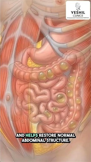 Umbilical Hernia Surgery Safe & Effective Repair