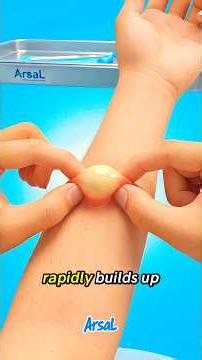 What ACTUALLY Happens When You Pop A Cyst 😱 (3D Animation)